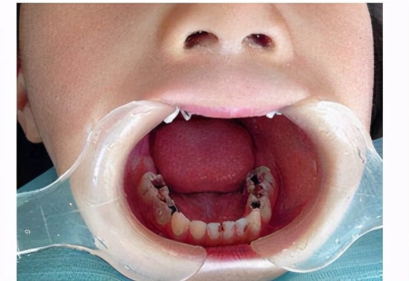 孩子龋齿晚上牙疼怎么缓解,儿童龋齿牙痛治疗方法