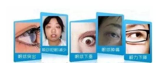 甲亢突眼怎么缓解,甲亢突眼什么原因