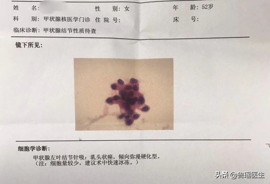 “大夫，我刚做完甲穿提示结节是良性，为什么还要让我做？”