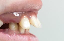 8岁的孩子能做牙齿矫正吗,7岁孩子矫正牙齿早吗