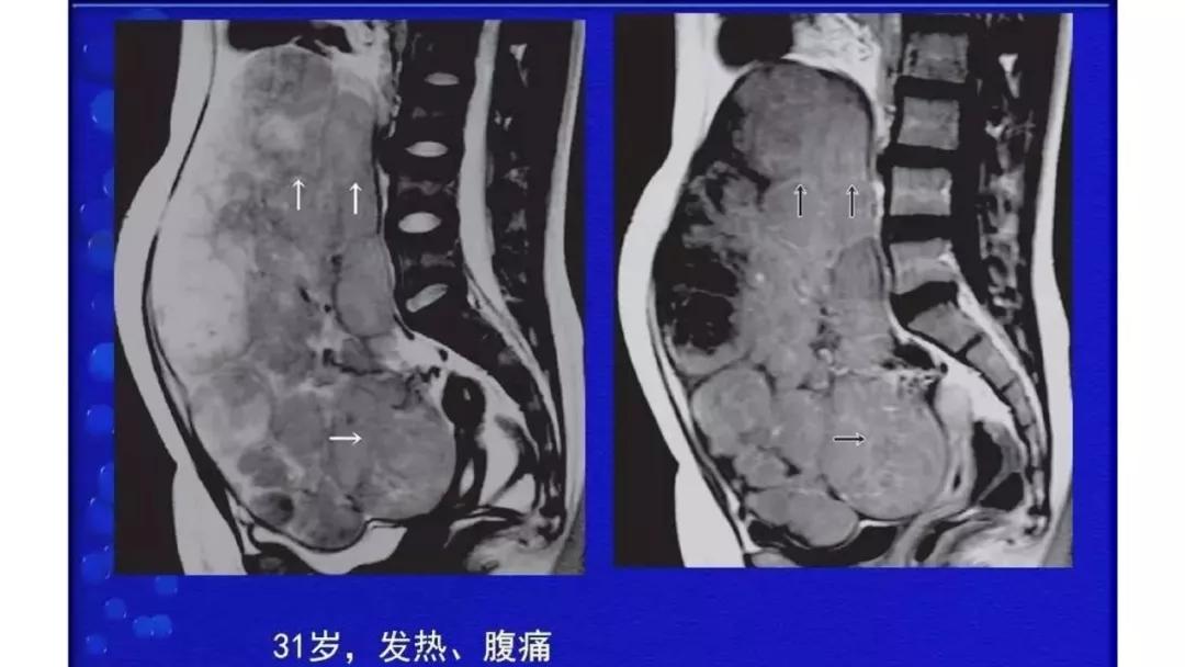 卵巢原发肿瘤的分析思路