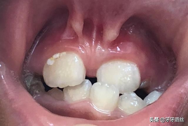 舌系带短会导致孩子不说话么,舌系带过短会影响孩子发音不准吗