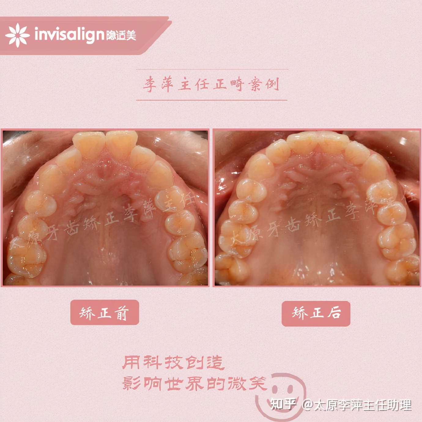 重度拥挤矫正牙齿适合隐形牙套吗,广州成人牙齿矫正推荐隐形牙套