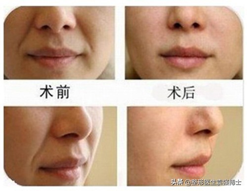 什么治法令纹最有效,天生就有法令纹去除不了吗