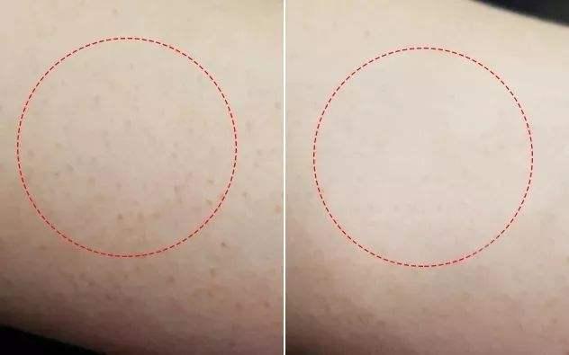 如何有效去鸡皮?3招教你和鸡皮说再见