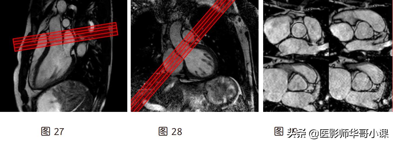 磁共振心脏扫描标准切面,心脏mri扫描定位