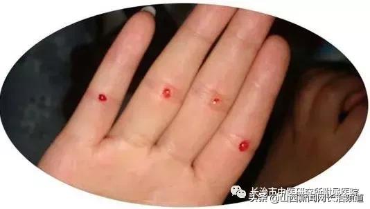 倪海厦讲惊蛰刺络放血,惊蛰四缝穴放血