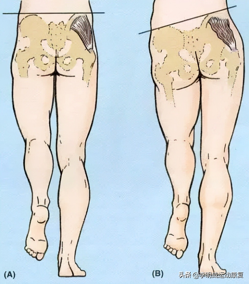 骨盆不正的危害动画视频,骨盆不正危害图片