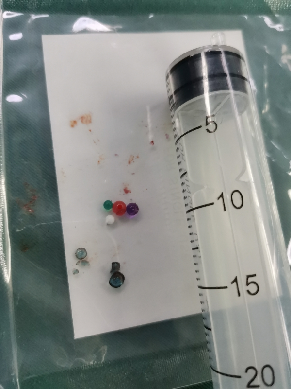 男童误把弹珠卡进鼻孔,男童弹珠塞入耳朵