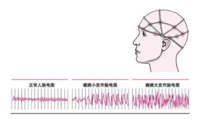 大脑受伤引起的癫痫怎么治疗,癫痫修复脑细胞的药