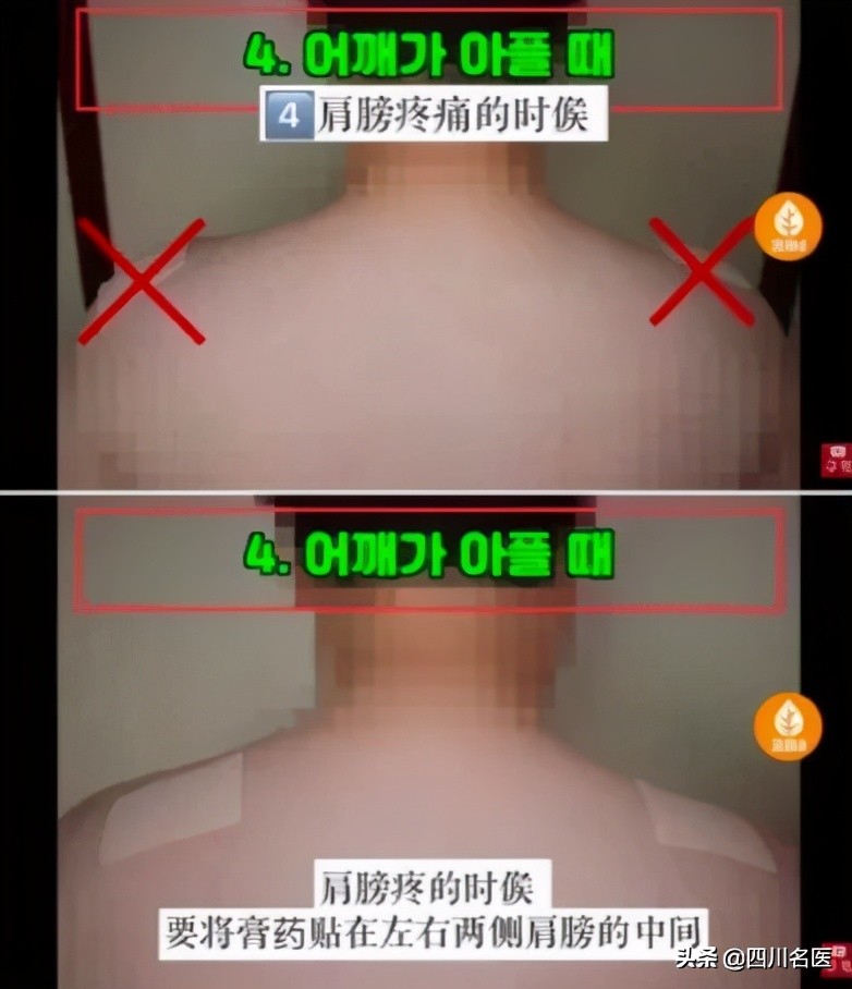 哪儿疼贴哪儿,膏药是不是哪儿疼贴哪儿