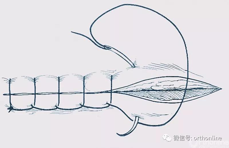 十种外科基本缝合方式详解,手术切口缝合有哪几种