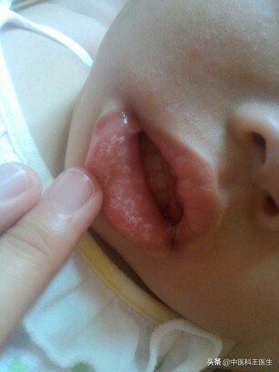 鹅口疮怎么才能不复发吃益生菌,鹅口疮怎么抹药更彻底不容易复发