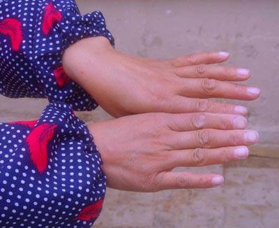 类风湿患者最好的治疗方法,类风湿痊愈患者经验