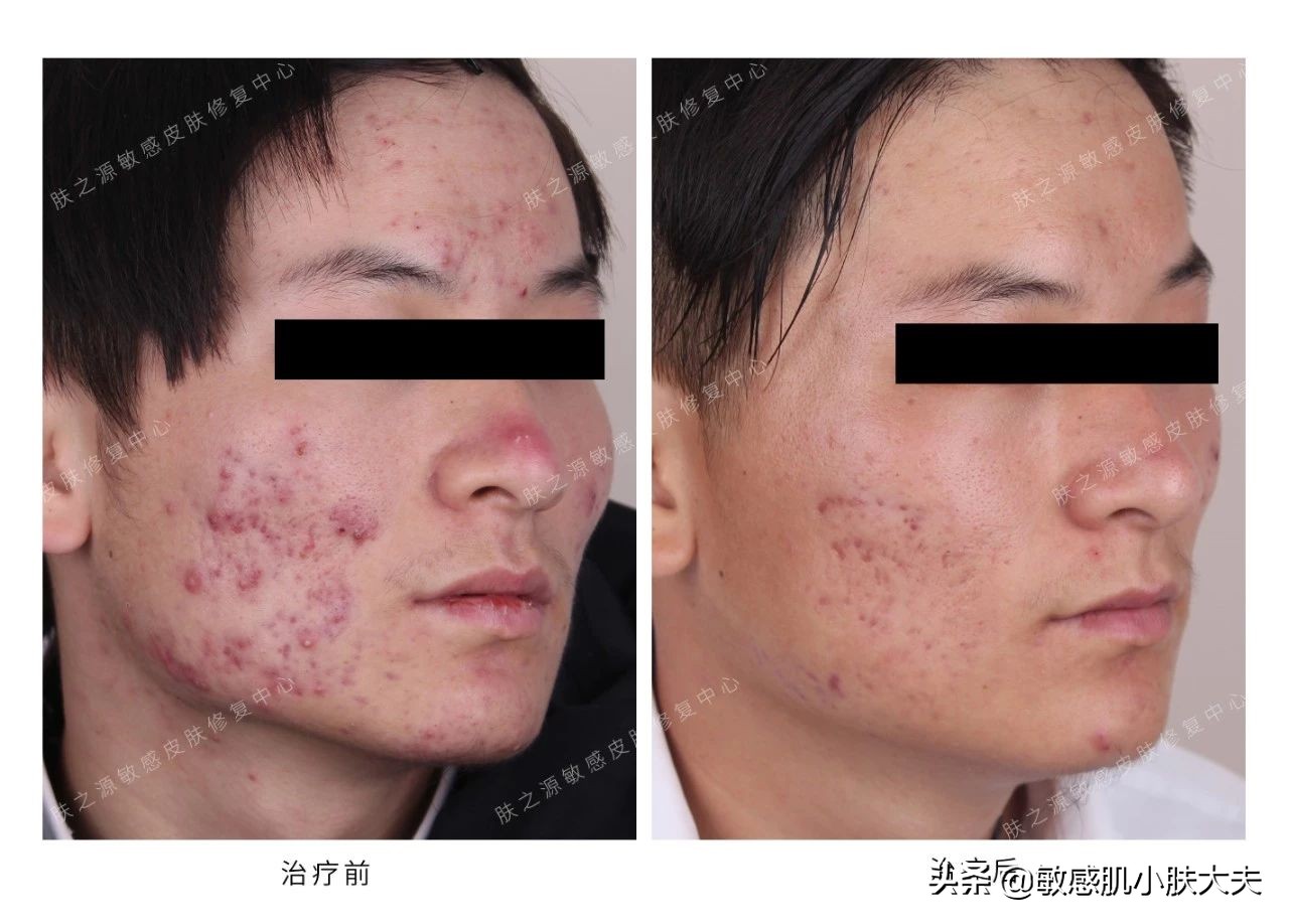 阿达帕林怎么用才正确,阿达帕林怎么用不烂脸