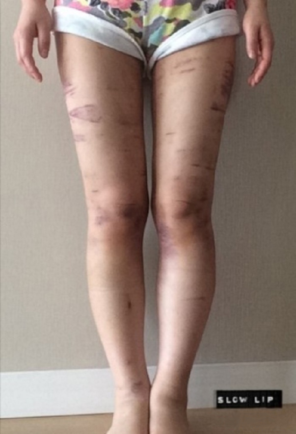 吸脂手术后，如何护理才能恢复更快！