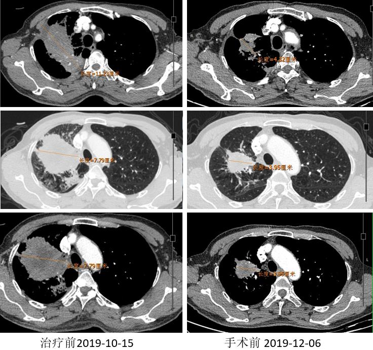 PD-1新辅助治疗初探，典型案例汇总一览