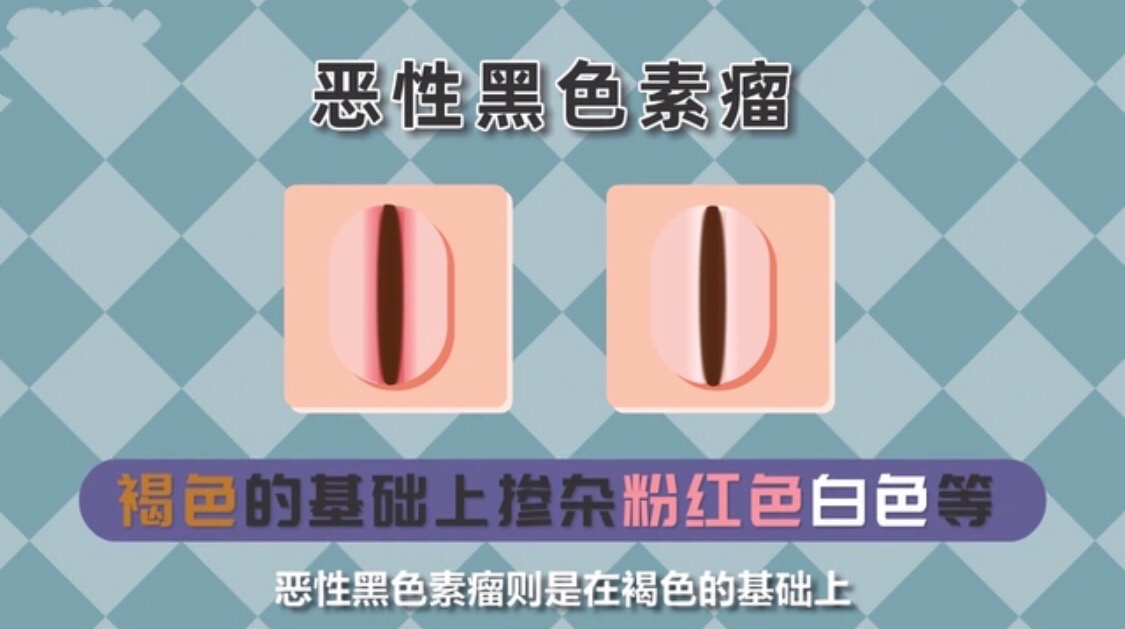 手指甲黑线怎么看是不是黑色素瘤,指甲有甲母痣会癌变吗