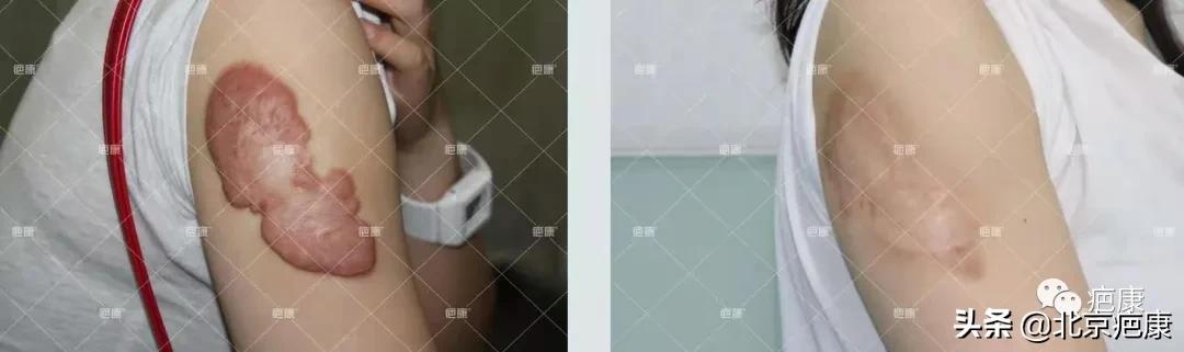 看到最后,为什么每个治疗中的人对疤友的建议都一样?