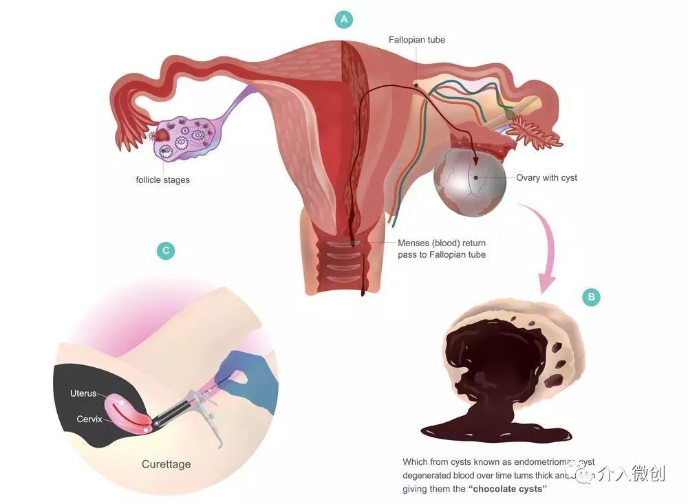 介入微创治疗巧克力囊肿