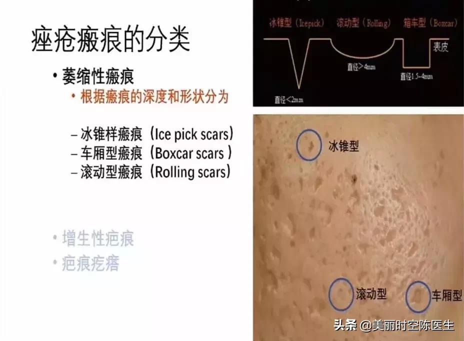 痘痘去了还要继续刷酸吗,痘痘去了还有红印记