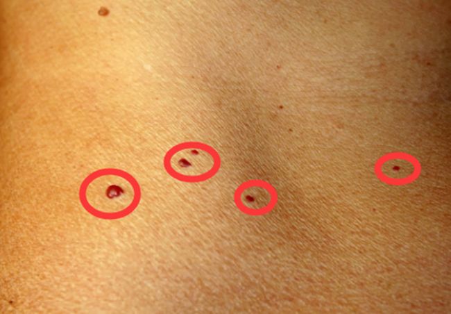 身上出现小红点一定要注意,身上的小红点是什么原因怎么治疗