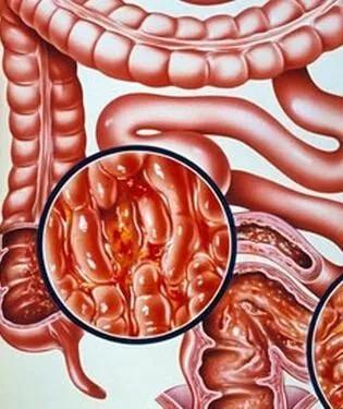 有肠炎的人怎样保健,敏感菌所致的肠炎症状有哪些