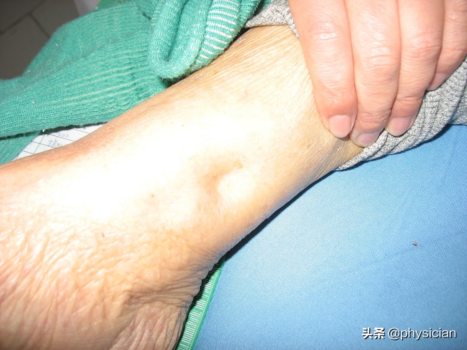 地平类降压药吃了头痛,吃地平类降压药头疼怎么办