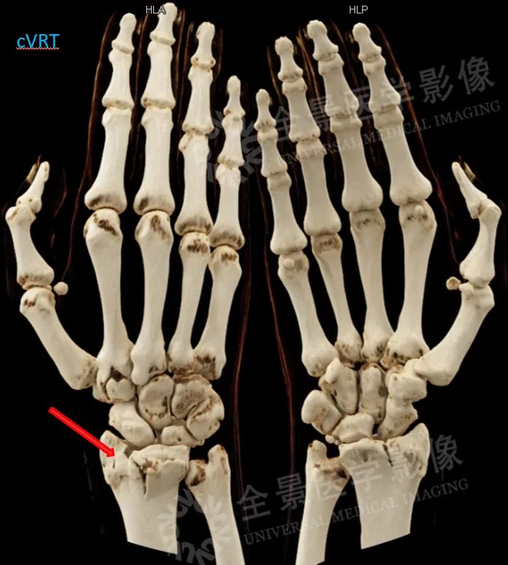 颈部肿块为什么有80%是肿瘤,颈部肿块1年没有变化