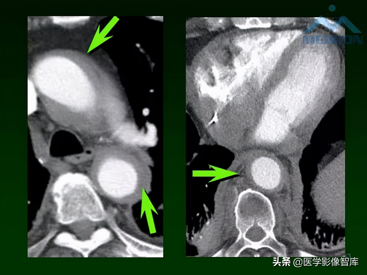 肺弥漫性网状影,两肺小叶间隔增厚可见网状模糊影