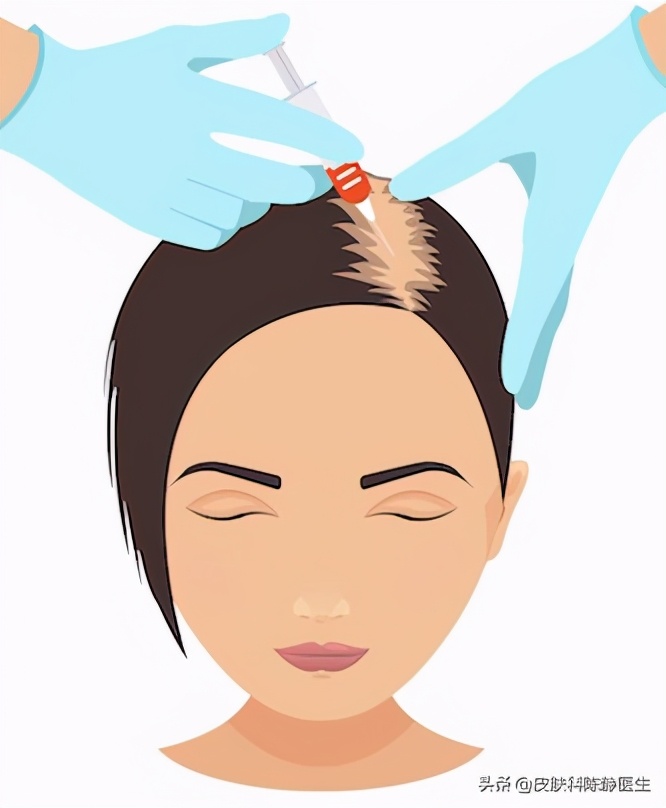 脱发最新研究成果与最新治疗方法,女性脱发严重怎么治疗才有效