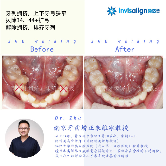 口腔正畸隐适美隐形矫治技术,隐适美深覆合矫正