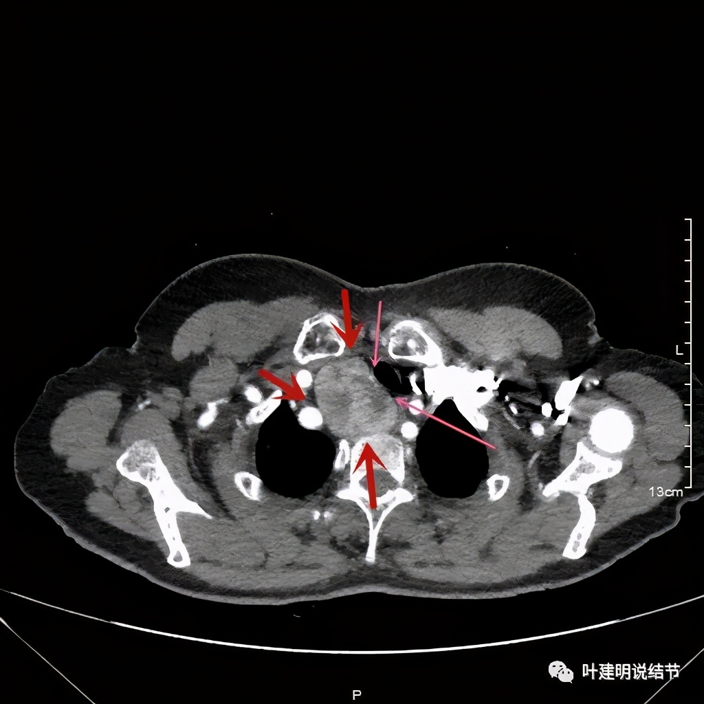 胸部高分辨ct检查注意事项,胸部ct扫描有没有危害