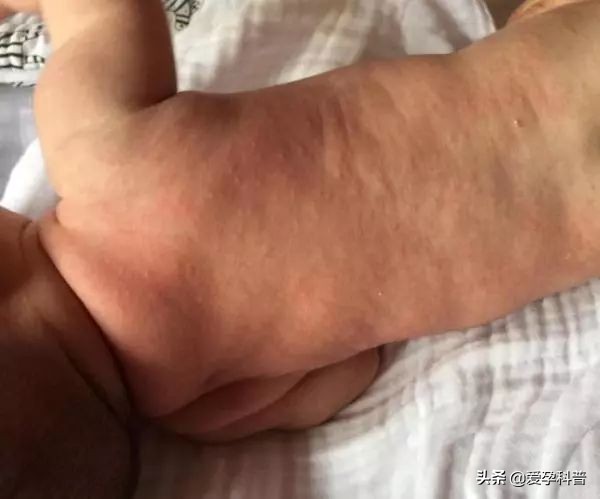 婴儿湿疹是胎毒引起的吗,宝宝长湿疹怎么表示自己不舒服