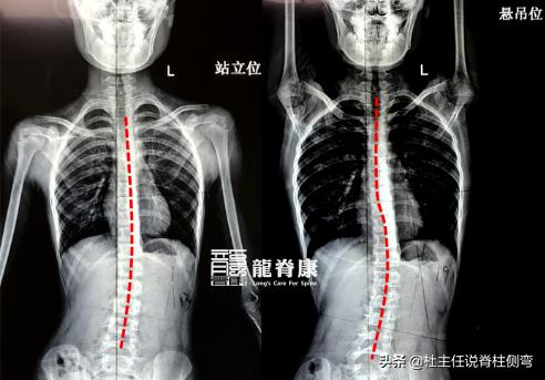 儿童脊柱侧弯单杠矫正正确姿势,脊柱侧弯拉单杠好还是吊单杠好