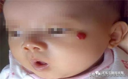 瘢痕疙瘩毛细血管扩张,毛细血管瘤治疗后留疤怎么去除