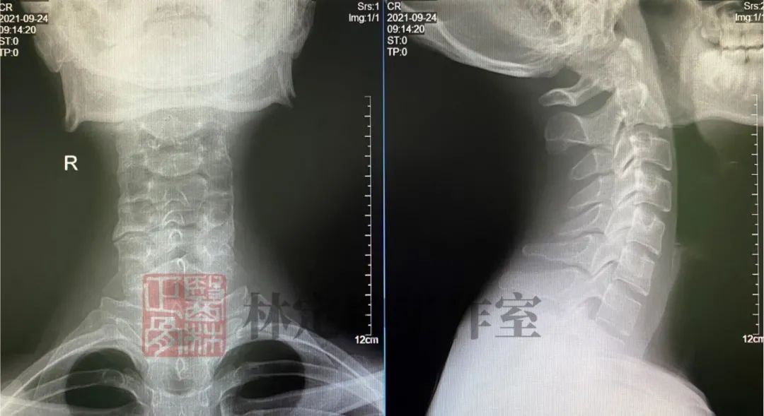 颈椎病的六种分型及专科检查,正骨治颈椎病需要几次