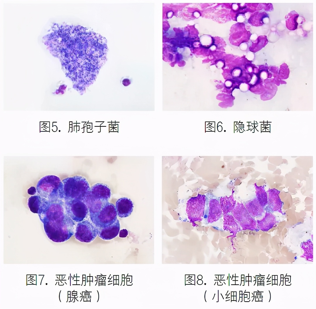 支气管肺泡灌洗液检测技术规范,肺泡灌洗液肿瘤细胞检查准确性