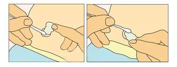 宝宝出生3天脐带流血化脓怎么办,婴儿脐带化脓出血怎么办