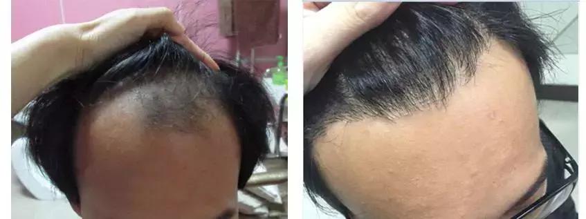 额头两边头发后移怎么治,两边额角头发向后移怎么办