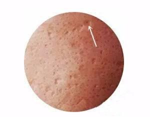 鼻子上痘印消不掉怎么办,青春期痘痘密集痘印消不掉怎么办