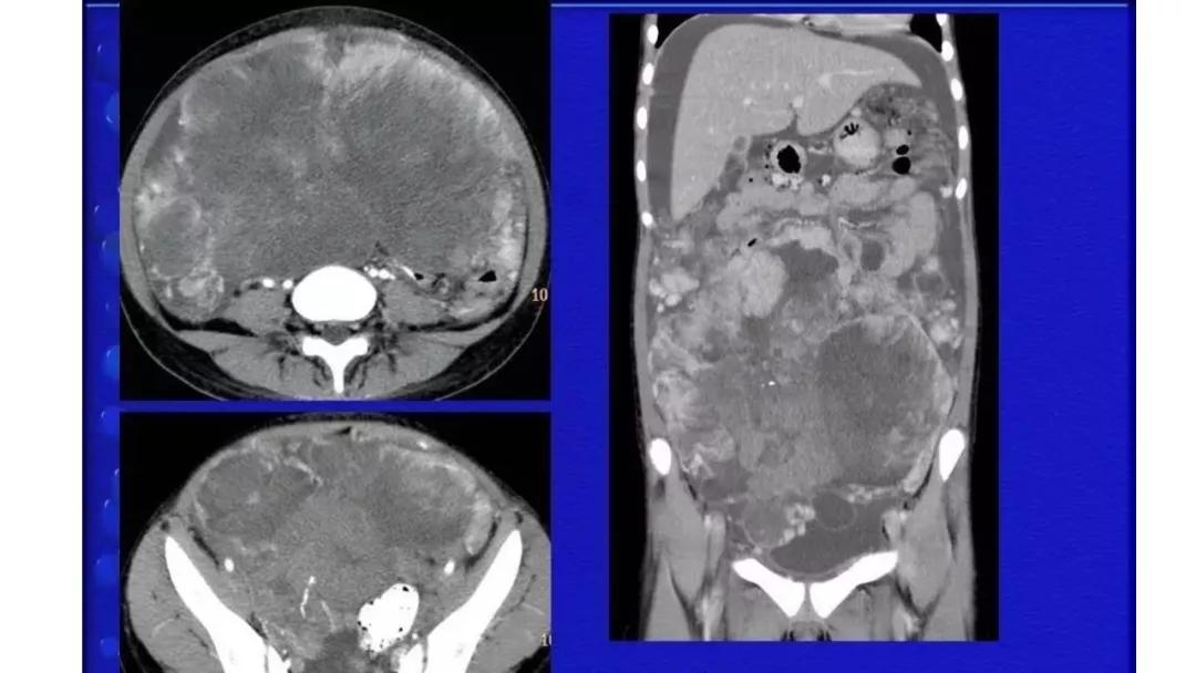 卵巢原发肿瘤的分析思路
