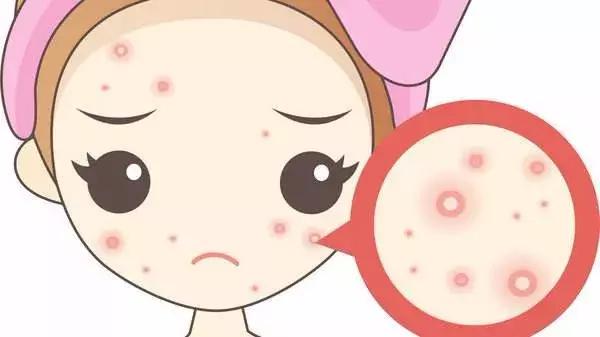 痘痘反反复复试试这招祛痘不用愁,青春期去除痘痘最有效的祛痘神器