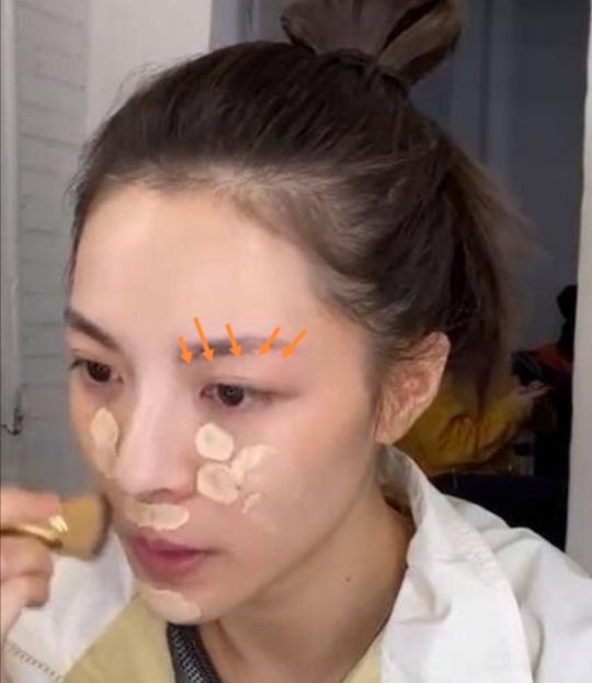 无眉星人怎么治疗,无眉星人怎么补救