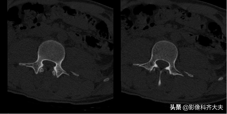 骨折的影像学检查及各自的优势,骨折的影像学愈合标准