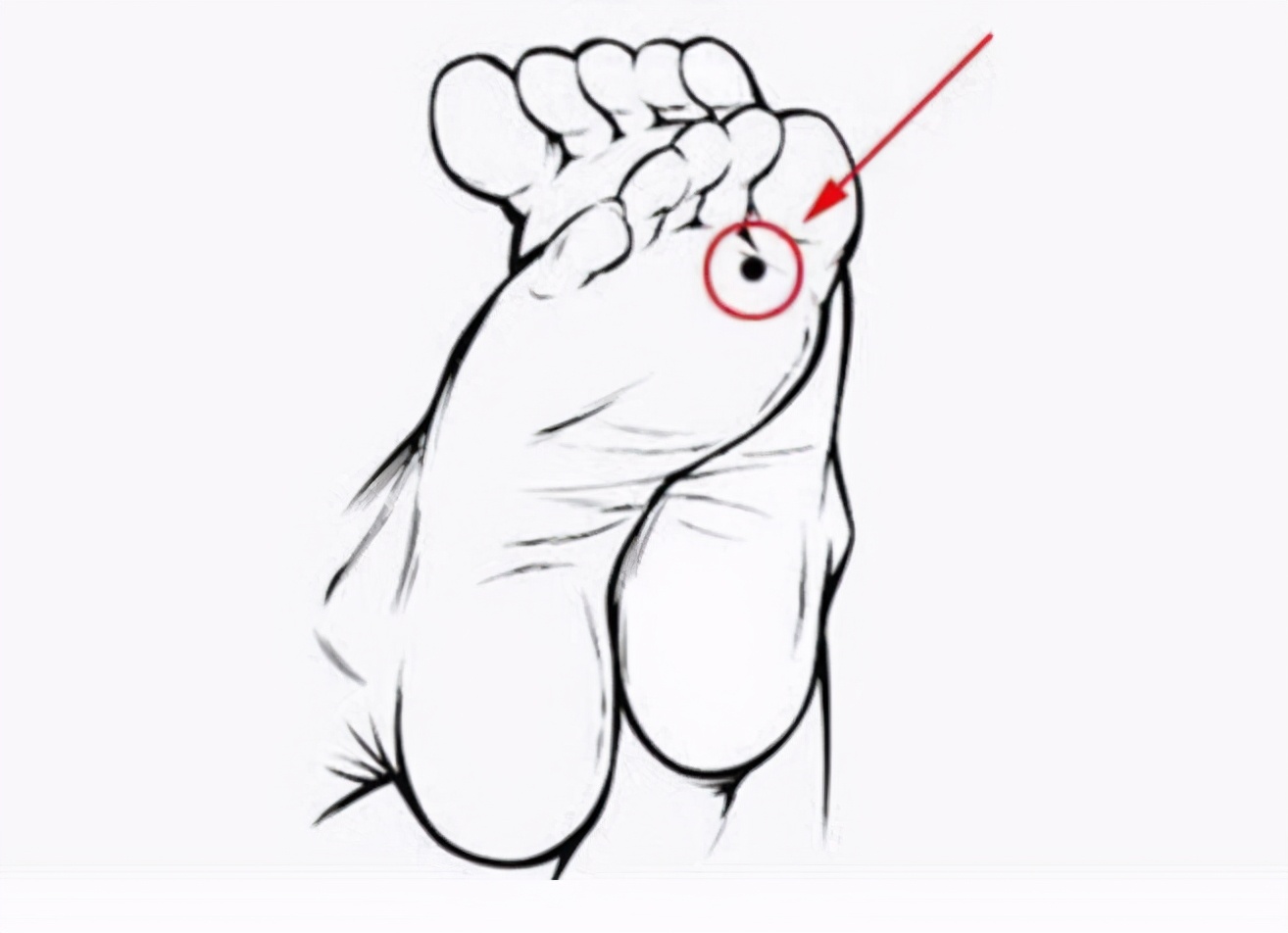 脚底黑色素痣病理结果有癌变,脚趾黑色素痣会很快恶变吗