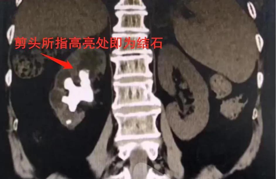 阜新治疗输尿管结石,肾盂大结石怎么处理最安全