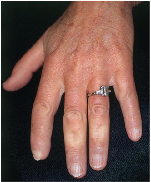 系统性硬化症/硬皮病是什么样的疾病?