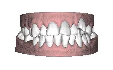 牙齿矫正全过程看完你就知道,目前几种常见的牙齿矫正方式