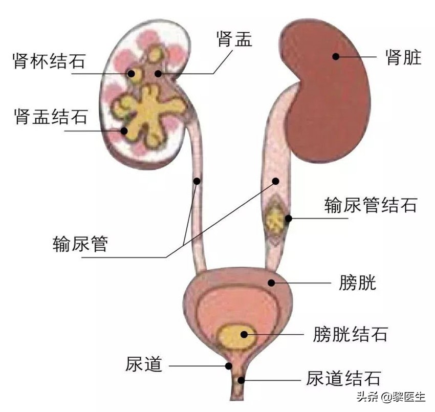 查出肾结石但是没感觉,查出肾结石腰不舒服需要碎石吗